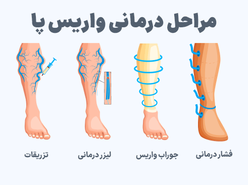 مراحل درمانی واریس پا