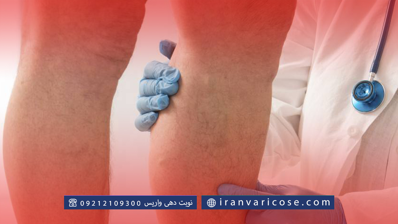 مقایسه فلبکتومی با روش‌های دیگر درمان واریس