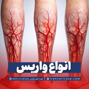 انواع واریس