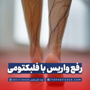 درمان واریس به روش فلبکتومی