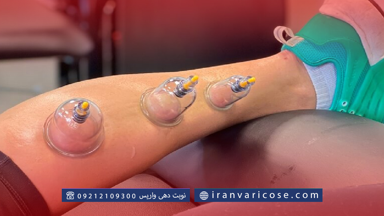 نحوه انجام حجامت برای واریس