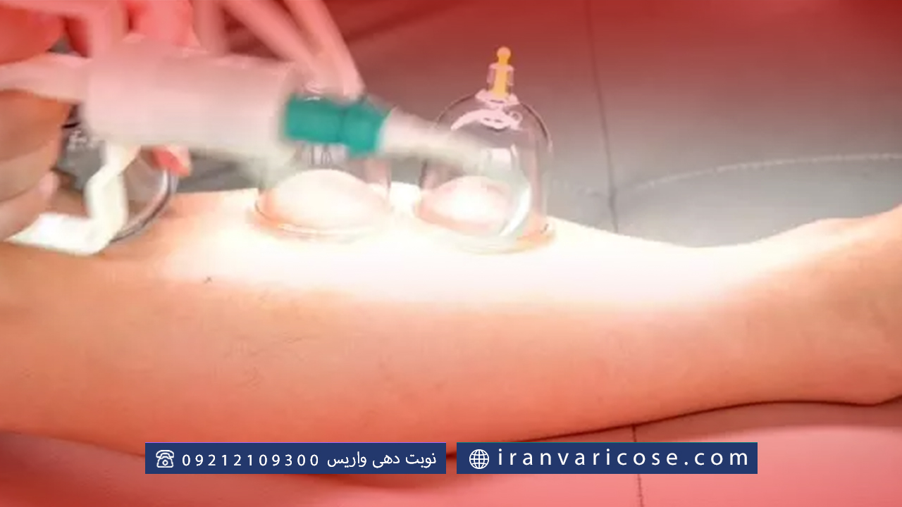 مزایا انجام حجامت برای واریس