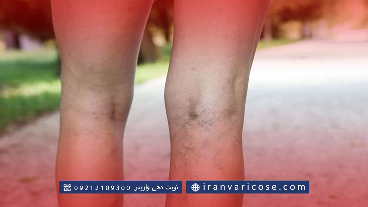 معایب ونوگرافی واریس