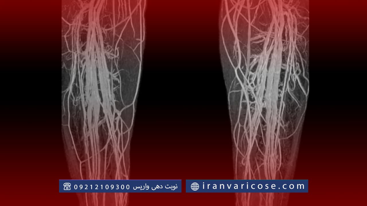 قبل و بعد از ونوگرافی واریس