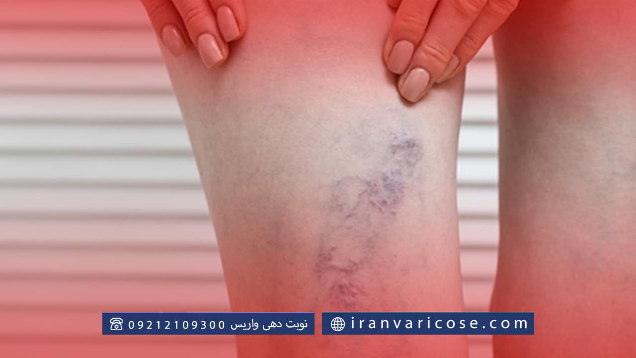 تفاوت چسب واریس با سایر روش های درمانی واریس
