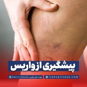 چگونگی پیشگیری از واریس پا