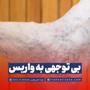 خطرات بی توجهی به واریس پا