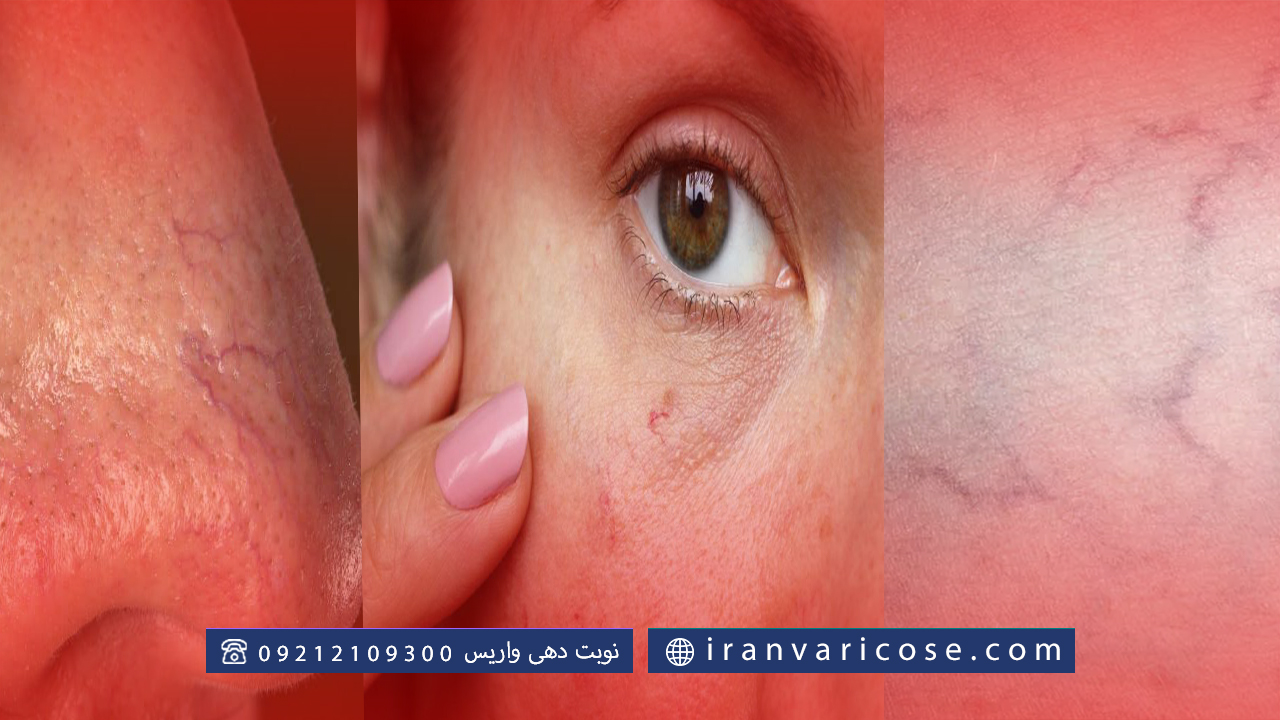 انواع واریس در قسمت‌های مختلف بدن