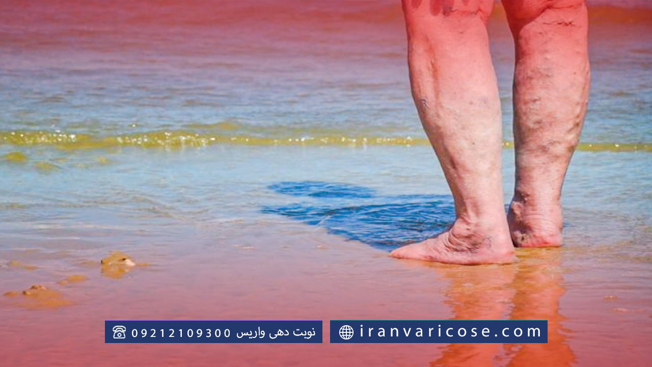 تاثیر آب درمانی روی واریس پا