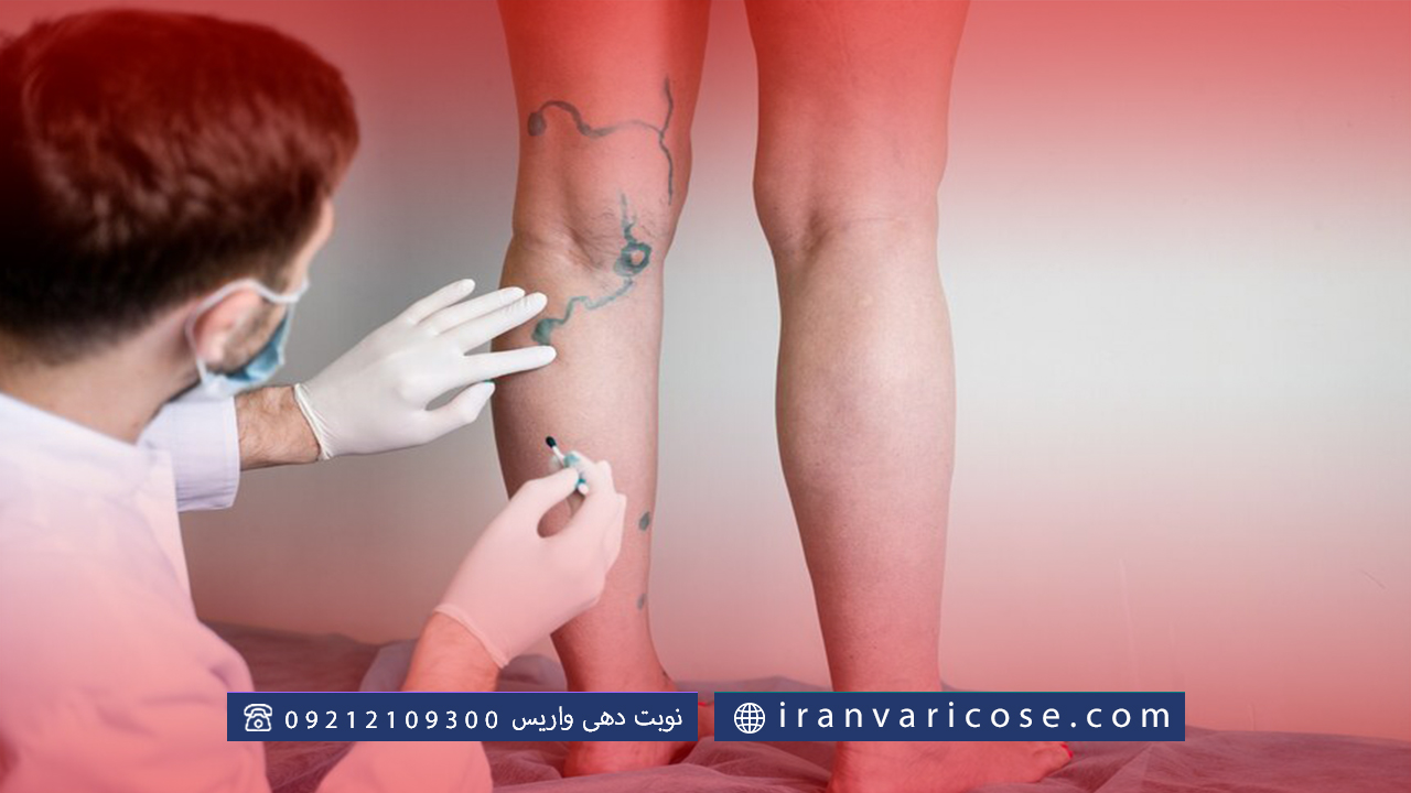 هزینه درمان واریس در کلینیک‌ های زیبایی