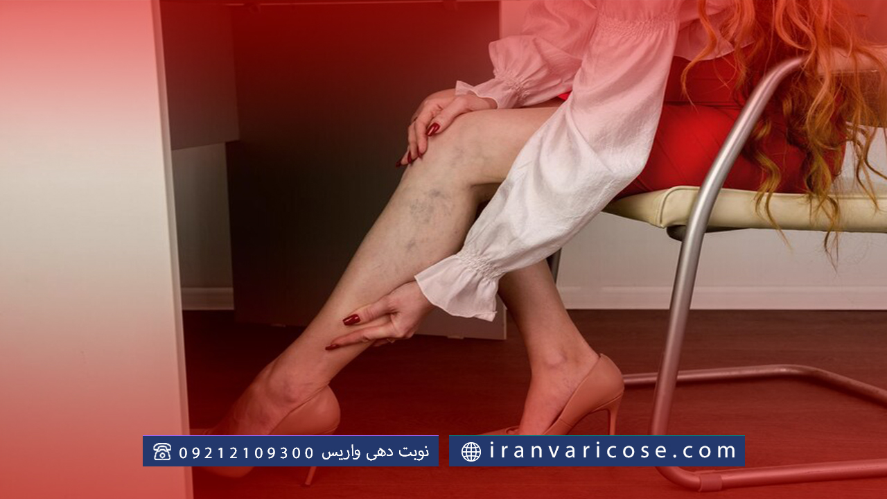 آیا واریس پا در زنان خطرناک است؟
