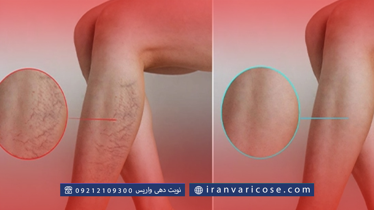 نقش فعالیت بدنی و ورزش در پیشگیری و درمان واریس پا