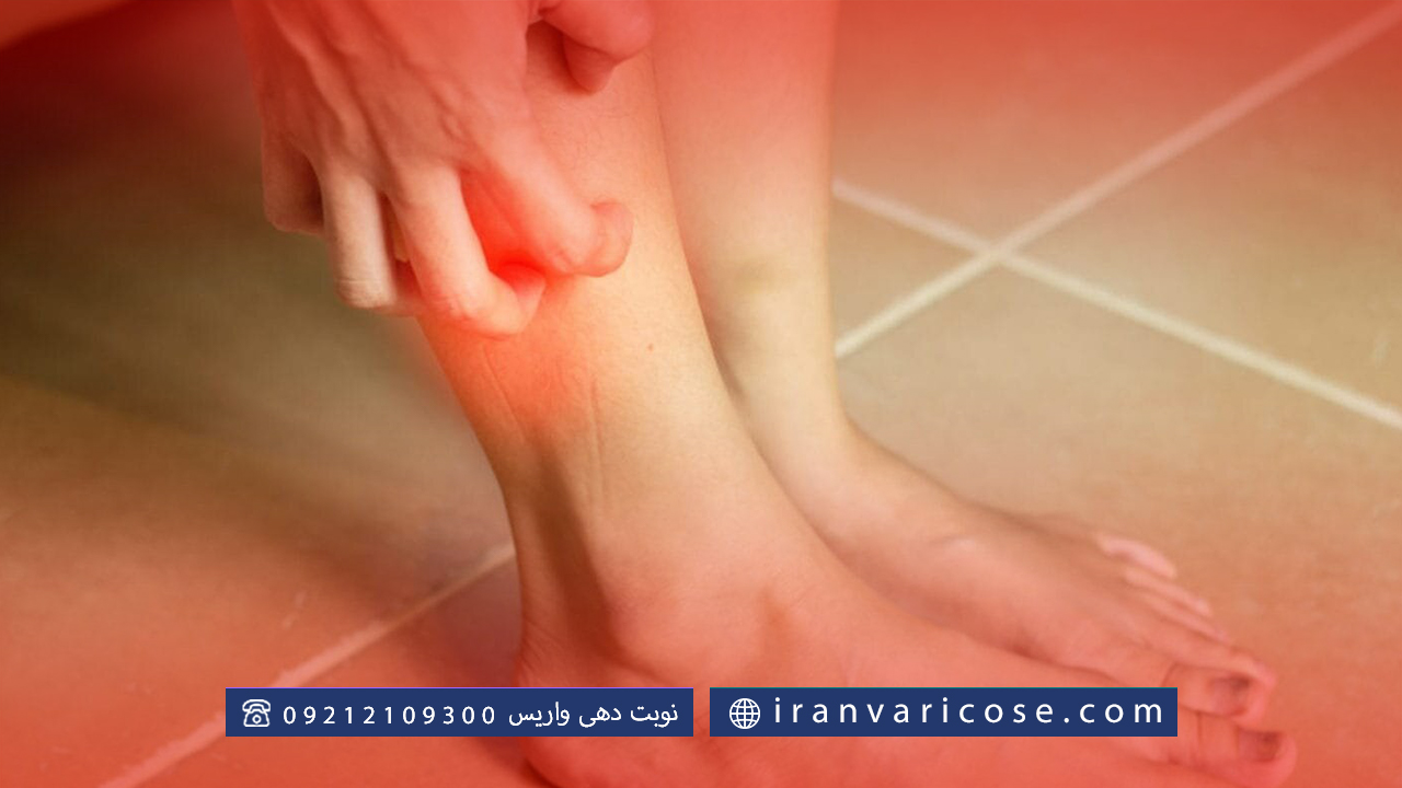 علت خارش واریس پا