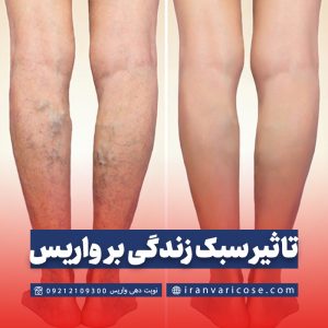 چگونه سبک زندگی بر نتایج درمان واریس پا تأثیر می‌گذارد؟