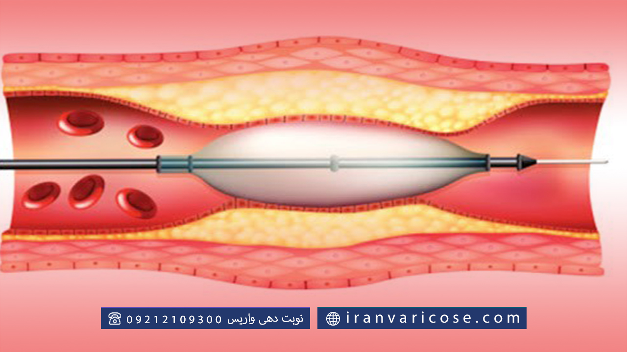 علل گرفتگی عروق پا