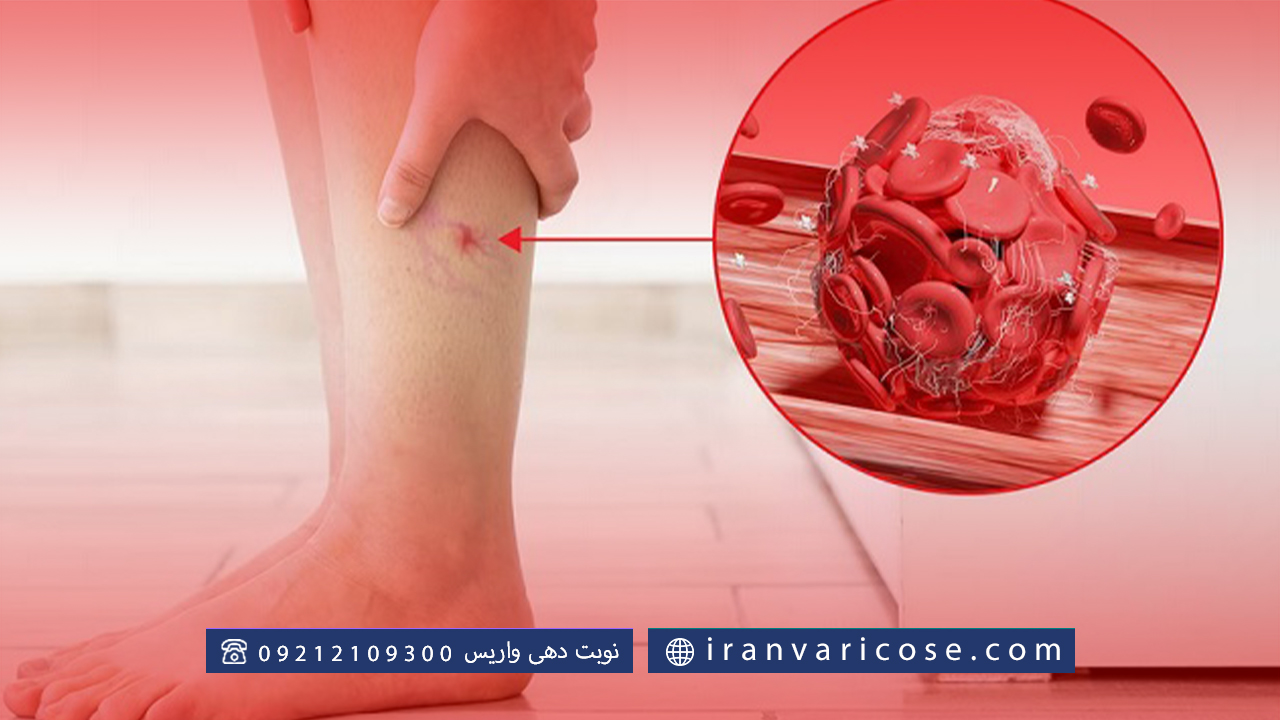 علائم اولیه لخته شدن خون در پا