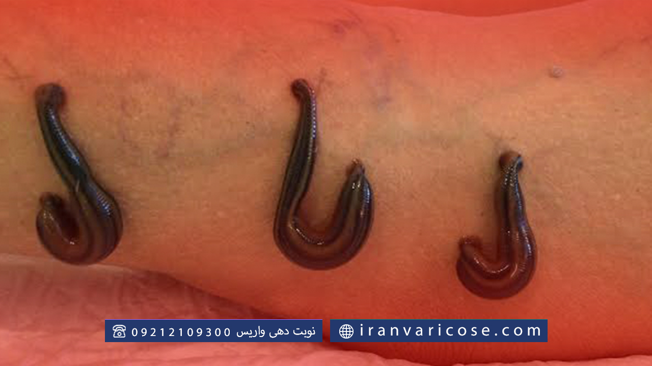زالو درمانی چیست و چگونه عمل می‌کند؟
