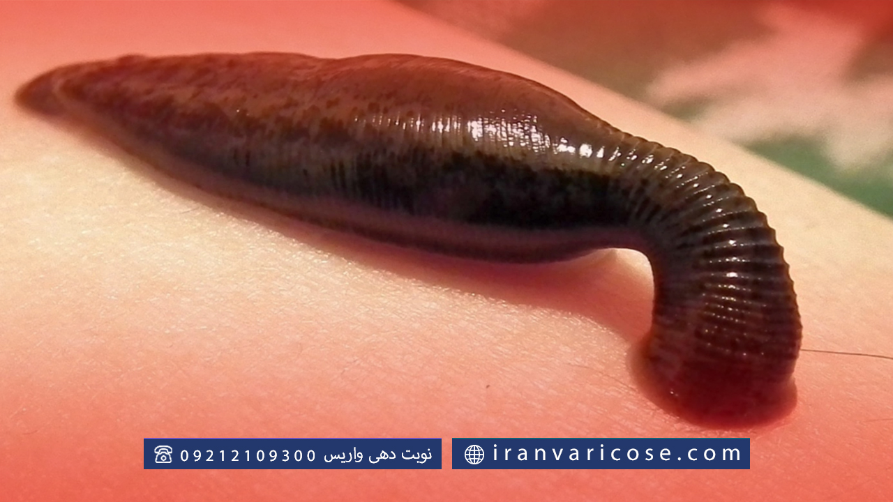 محدودیت‌ ها و موارد منع استفاده از درمان واریس پا با زالو