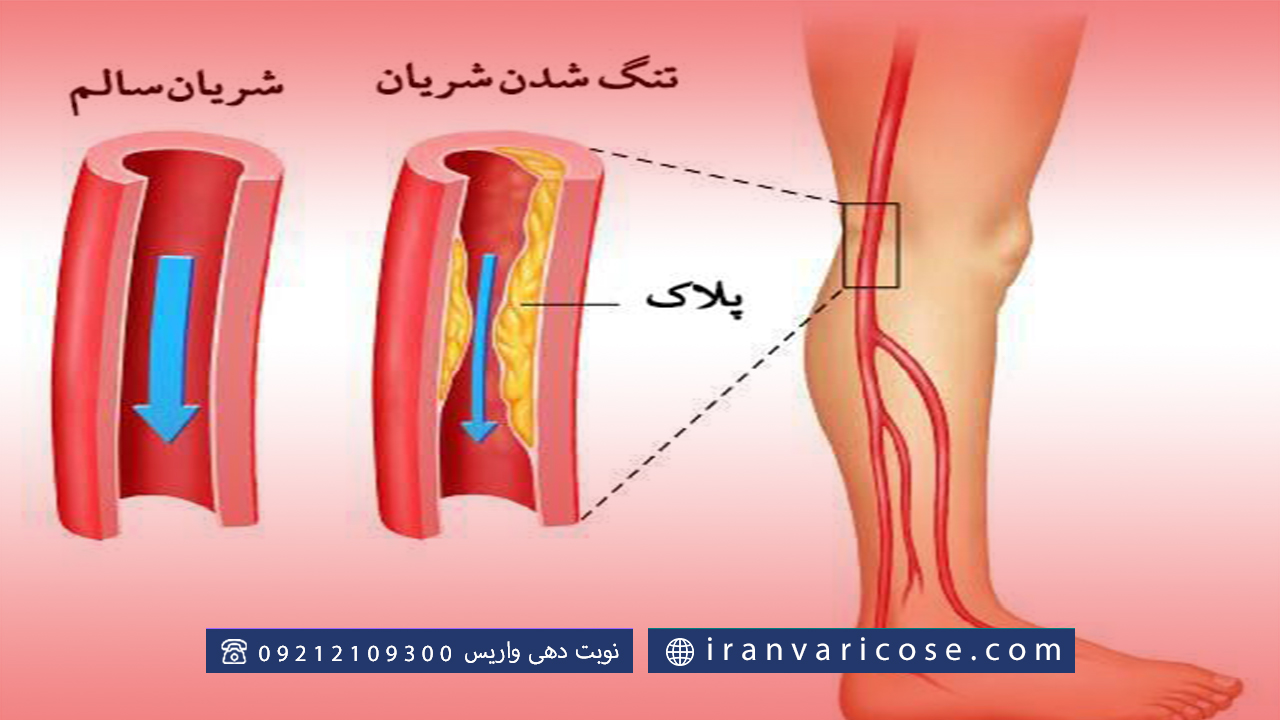 مزایا آنژیوپلاستی عروق پا