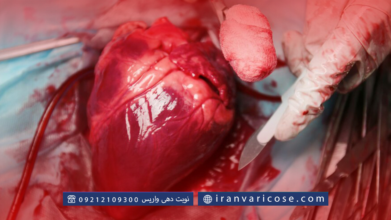 چه زمانی باید آنژیوپلاستی انجام داد؟