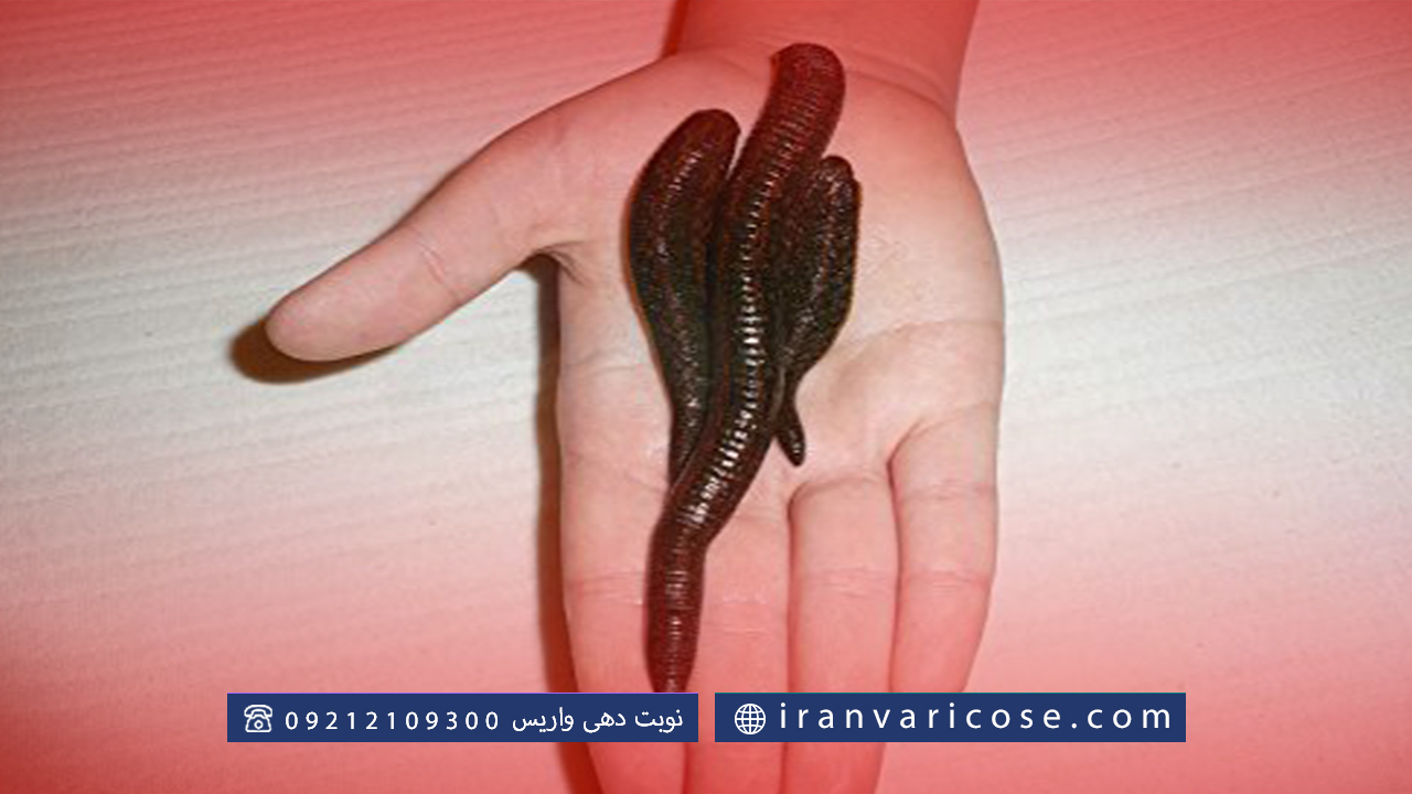 هزینه‌ درمان واریس پا با زالو در مقایسه با دیگر روش ها