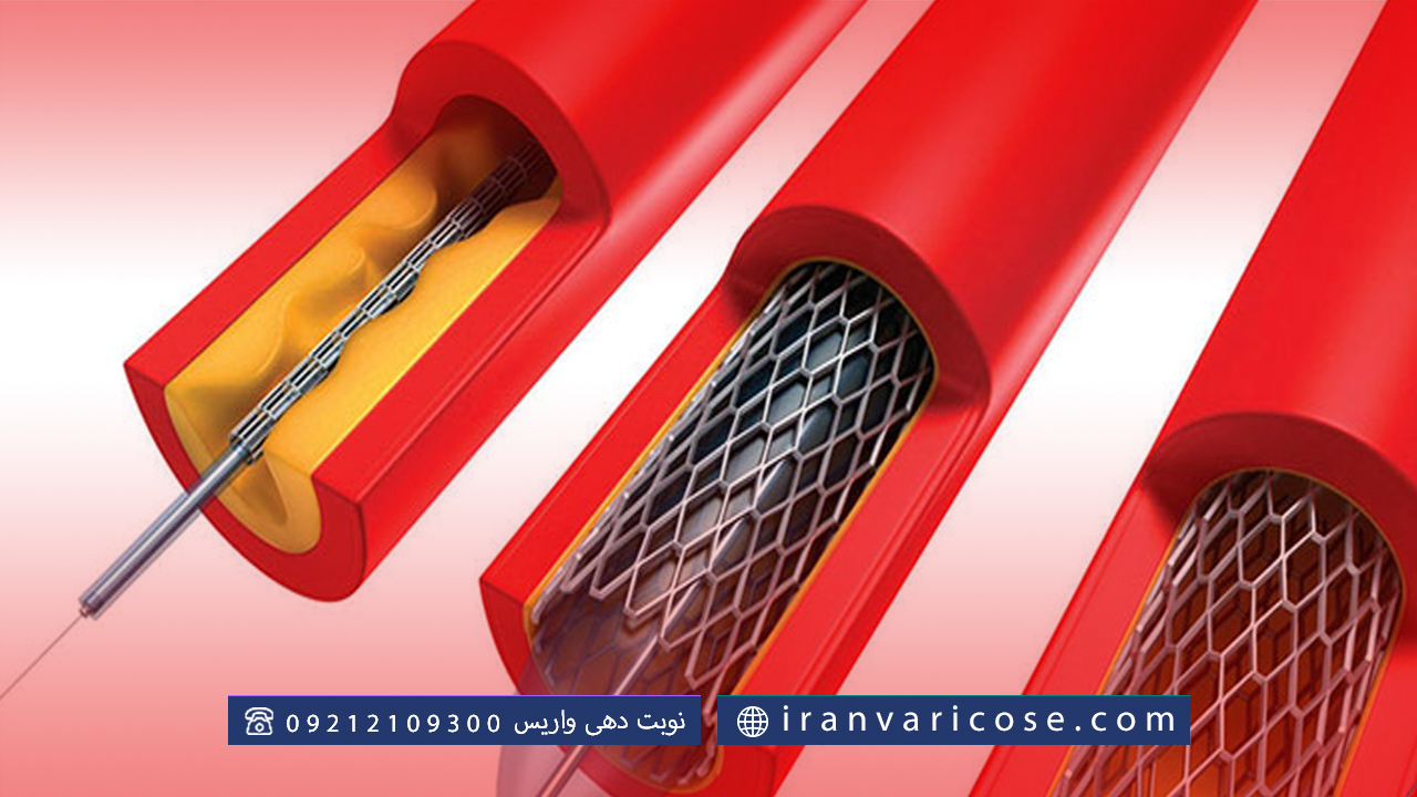 عوارض آنژیوپلاستی عروق پا