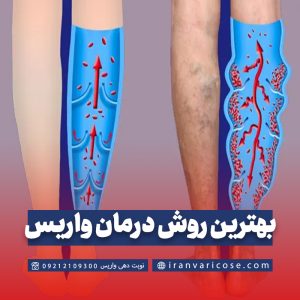 بهترین روش درمان واریس پا