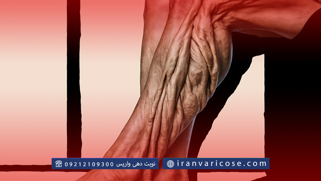 عوارض عدم درمان واریس لگنی