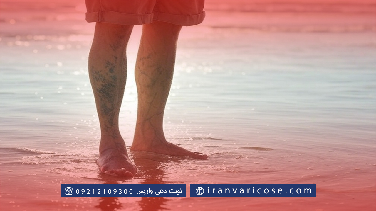 عوارض استفاده از آب نمک برای درمان واریس